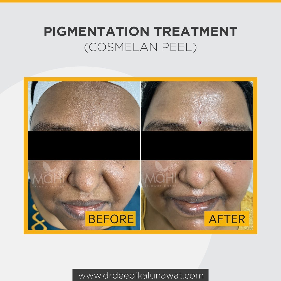 Pigmentation treatment before after Chennai — Cosmelan Peel at Mahi