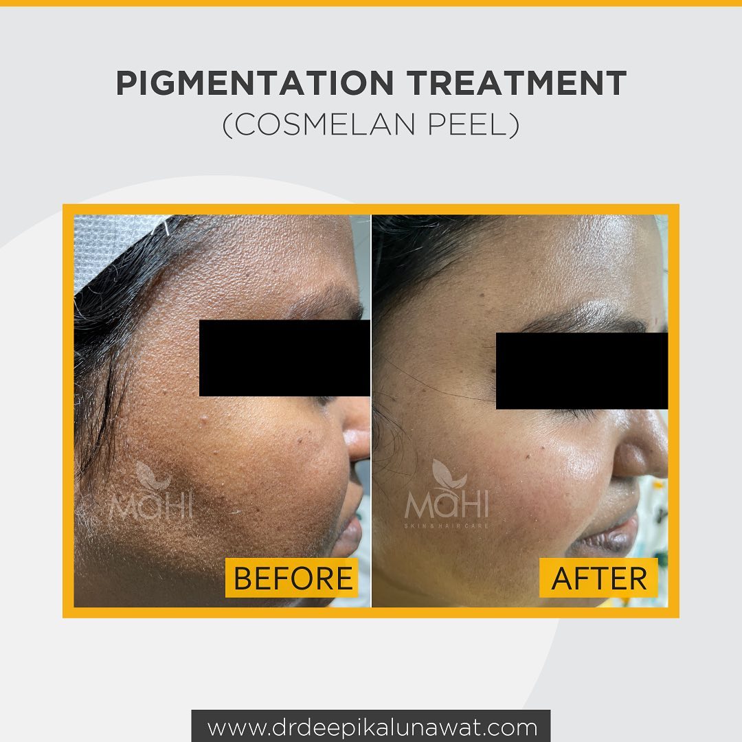 Chemical peel pigmentation before after Chennai — Mahi Skin Clinic