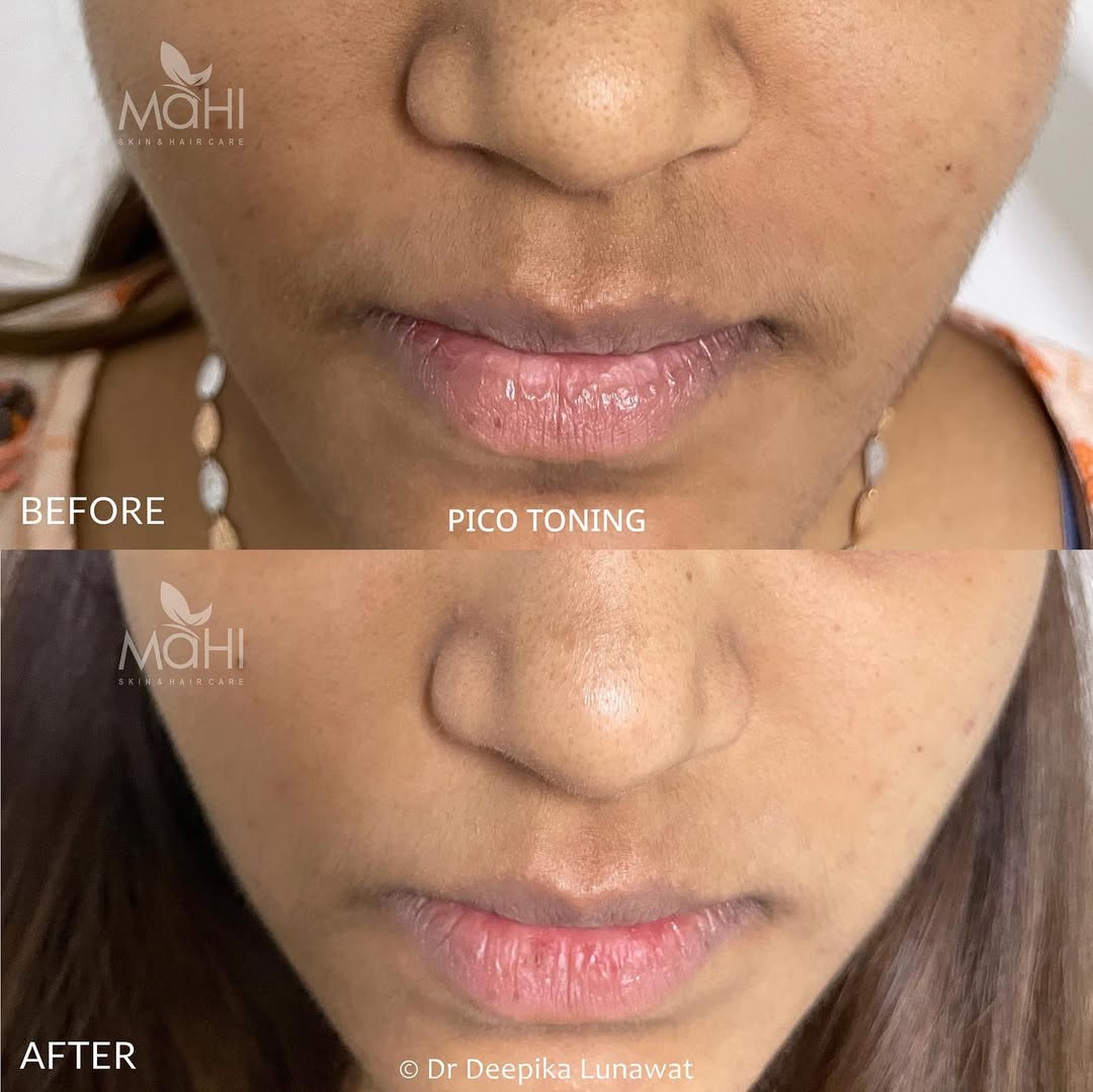 PICO laser pigmentation before after Chennai — Mahi Skin Clinic